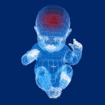 Intracranial Hemorrhage