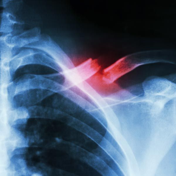 bone fracture